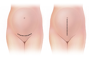 Pregnant abdomen showing low transverse incision. Pregnant abdomen showing midline vertical incision.