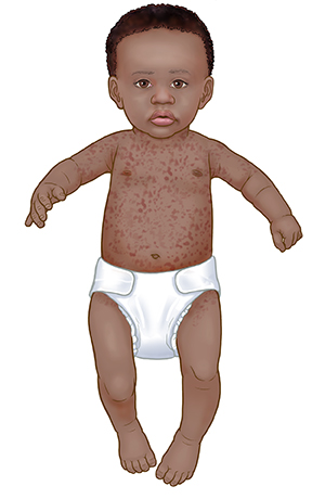 Infant with roseola rash on neck, arms, and torso.