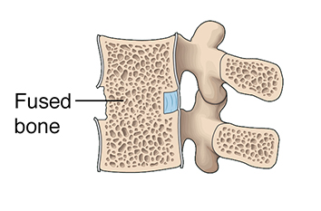 Cross section of lumbar vertebrae showing fused bone between vertebrae.