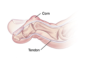 Side view of toe showing corn and flexible hammertoe.