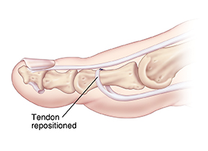 Side view of toe showing flexor tendon transfer.