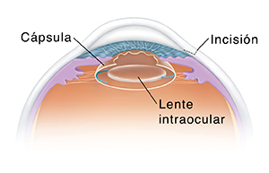 Corte transversal de un ojo que muestra el implante del lente intraocular.