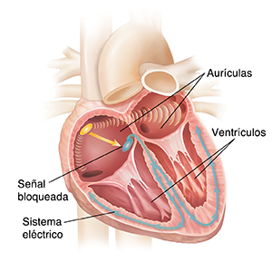 Corte transversal del corazón en el que puede verse la señal eléctrica bloqueada en el nodo sinoauricular.