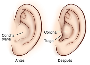 Vista lateral de la oreja antes y después de la reconstrucción de la concha y del trago.