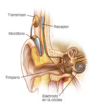 Vista frontal del oído interno con un implante coclear.