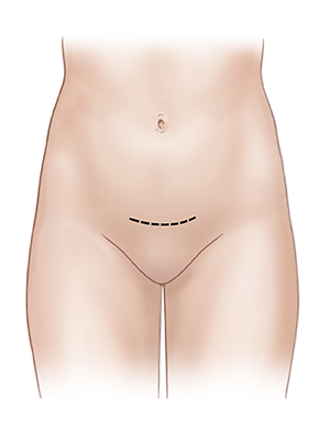 Vista frontal de un abdomen femenino donde se observa una incisión en la parte baja del abdomen.