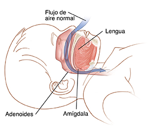 Contorno de la cabeza de un niño que muestra la lengua, las adenoides y las amígdalas. La flecha muestra el flujo de aire normal que pasa por la nariz, las adenoides y las amígdalas.