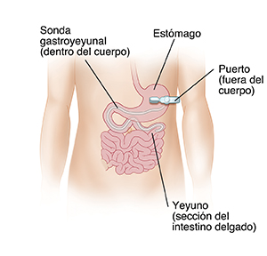 Vista frontal del abdomen con una sonda de gastroyeyunostomía insertada a través de la pared del cuerpo hacia el interior del estómago. La sonda ingresa en el intestino delgado.