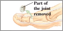 Imagen de una articulación extirpada de un dedo del pie (artroplastia)