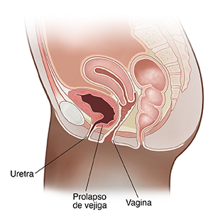 Vista lateral de corte transversal de la pelvis femenina donde se observa el prolapso de vejiga (cistocele).