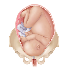 Vista frontal de un feto a término completo en un útero en los huesos pélvicos, con la cabeza hacia abajo. La cabeza y el cuerpo son demasiado grandes para el canal de parto.